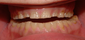 Bruxism related to daily stress